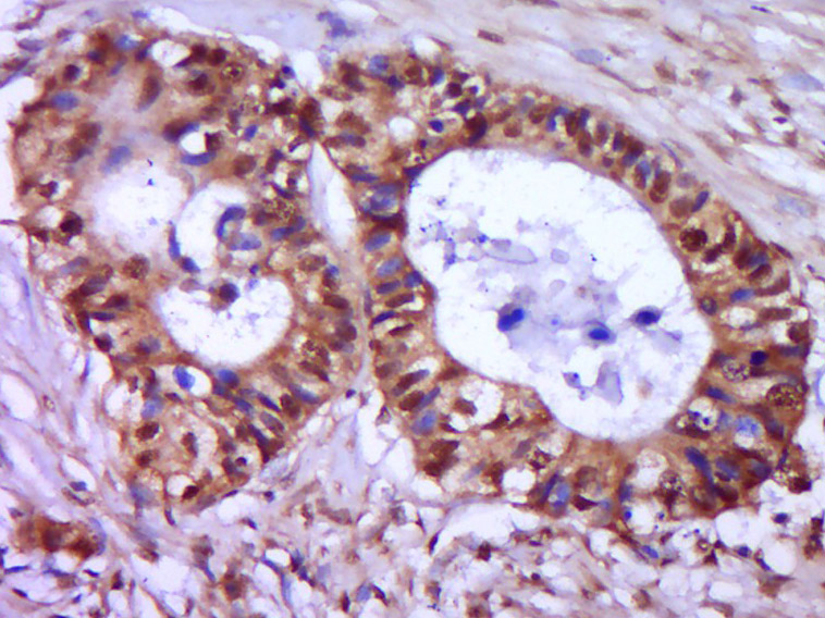 Paraformaldehyde-fixed, paraffin embedded Human cervical cancer; Antigen retrieval by boiling in sodium citrate buffer (pH6.0) for 15min; Block endogenous peroxidase by 3% hydrogen peroxide for 20 minutes; Blocking buffer (normal goat serum) at 37°C for 30min; Antibody incubation with CDKN1A (Ser130) Polyclonal Antibody, Unconjugated (bs-5274R) at 1:400 overnight at 4°C, DAB staining. Paraformaldehyde-fixed, paraffin embedded Human cervical cancer; Antigen retrieval by boiling in sodium citrate buffer (pH6.0) for 15min; Block endogenous peroxidase by 3% hydrogen peroxide for 20 minutes; Blocking buffer (normal goat serum) at 37°C for 30min; Antibody incubation with CDKN1A (Ser130) Polyclonal Antibody, Unconjugated (bs-5274R) at 1:400 overnight at 4°C, DAB staining.