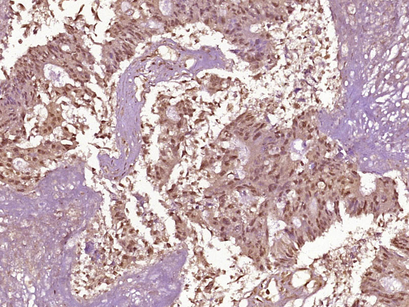 Paraformaldehyde-fixed, paraffin embedded Human gastric carcinoma; Antigen retrieval by boiling in sodium citrate buffer (pH6.0) for 15min; Block endogenous peroxidase by 3% hydrogen peroxide for 20 minutes; Blocking buffer (normal goat serum) at 37°C for 30min; Antibody incubation with NFKB p65(Thr254) Polyclonal Antibody, Unconjugated (bs-5662R) at 1:400 overnight at 4°C, DAB staining.