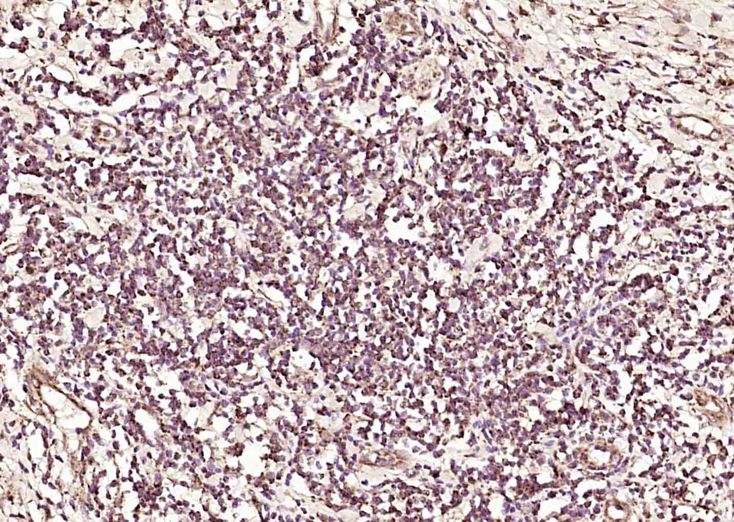 Paraformaldehyde-fixed, paraffin embedded Human gastric carcinoma; Antigen retrieval by boiling in sodium citrate buffer (pH6.0) for 15min; Block endogenous peroxidase by 3% hydrogen peroxide for 20 minutes; Blocking buffer (normal goat serum) at 37°C for 30min; Antibody incubation with RBM3 Polyclonal Antibody, Unconjugated (bs-5902R) at 1:200 overnight at 4°C, DAB staining. Paraformaldehyde-fixed, paraffin embedded Human gastric carcinoma; Antigen retrieval by boiling in sodium citrate buffer (pH6.0) for 15min; Block endogenous peroxidase by 3% hydrogen peroxide for 20 minutes; Blocking buffer (normal goat serum) at 37°C for 30min; Antibody incubation with RBM3 Polyclonal Antibody, Unconjugated (bs-5902R) at 1:200 overnight at 4°C, DAB staining.