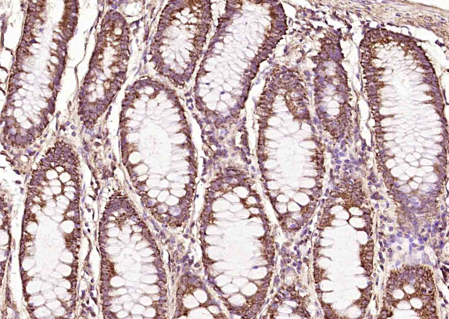 Paraformaldehyde-fixed, paraffin embedded Human colon cancer; Antigen retrieval by boiling in sodium citrate buffer (pH6.0) for 15min; Block endogenous peroxidase by 3% hydrogen peroxide for 20 minutes; Blocking buffer (normal goat serum) at 37°C for 30min; Antibody incubation with RBM3 Polyclonal Antibody, Unconjugated (bs-5902R) at 1:200 overnight at 4°C, DAB staining. Paraformaldehyde-fixed, paraffin embedded Human colon cancer; Antigen retrieval by boiling in sodium citrate buffer (pH6.0) for 15min; Block endogenous peroxidase by 3% hydrogen peroxide for 20 minutes; Blocking buffer (normal goat serum) at 37°C for 30min; Antibody incubation with RBM3 Polyclonal Antibody, Unconjugated (bs-5902R) at 1:200 overnight at 4°C, DAB staining.