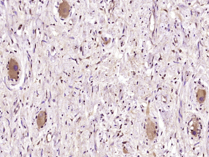 Paraformaldehyde-fixed, paraffin embedded Human ovarian cancer; Antigen retrieval by boiling in sodium citrate buffer (pH6.0) for 15min; Block endogenous peroxidase by 3% hydrogen peroxide for 20 minutes; Blocking buffer (normal goat serum) at 37°C for 30min; Antibody incubation with BRCAA1 Polyclonal Antibody, Unconjugated (bs-5992R) at 1:400 overnight at 4°C, DAB staining.
