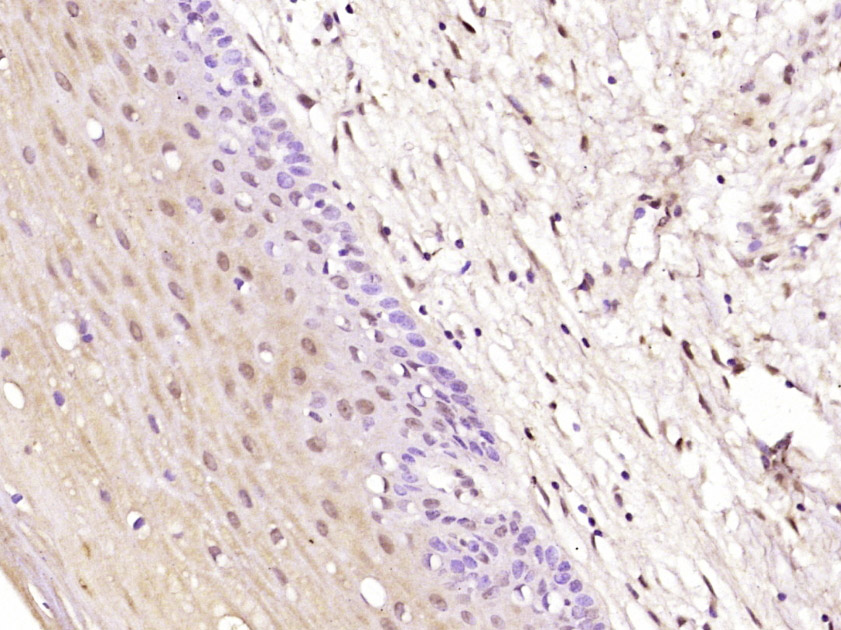 Paraformaldehyde-fixed, paraffin embedded Human cervical cancer; Antigen retrieval by boiling in sodium citrate buffer (pH6.0) for 15min; Block endogenous peroxidase by 3% hydrogen peroxide for 20 minutes; Blocking buffer (normal goat serum) at 37°C for 30min; Antibody incubation with BRCAA1 Polyclonal Antibody, Unconjugated (bs-5992R) at 1:400 overnight at 4°C, DAB staining.