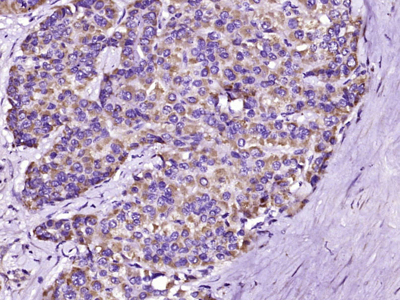 Paraformaldehyde-fixed, paraffin embedded Human liver cancer; Antigen retrieval by boiling in sodium citrate buffer (pH6.0) for 15min; Block endogenous peroxidase by 3% hydrogen peroxide for 20 minutes; Blocking buffer (normal goat serum) at 37°C for 30min; Antibody incubation with RASSF3 Polyclonal Antibody, Unconjugated (bs-6078R) at 1:400 overnight at 4°C, DAB staining. Paraformaldehyde-fixed, paraffin embedded Human liver cancer; Antigen retrieval by boiling in sodium citrate buffer (pH6.0) for 15min; Block endogenous peroxidase by 3% hydrogen peroxide for 20 minutes; Blocking buffer (normal goat serum) at 37°C for 30min; Antibody incubation with RASSF3 Polyclonal Antibody, Unconjugated (bs-6078R) at 1:400 overnight at 4°C, DAB staining.