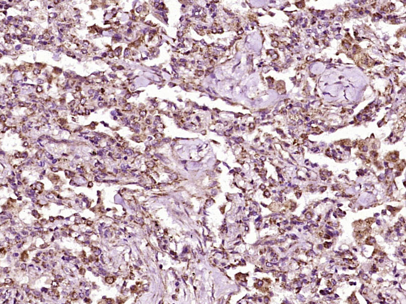 Paraformaldehyde-fixed, paraffin embedded Human lung cancer; Antigen retrieval by boiling in sodium citrate buffer (pH6.0) for 15min; Block endogenous peroxidase by 3% hydrogen peroxide for 20 minutes; Blocking buffer (normal goat serum) at 37°C for 30min; Antibody incubation with RASSF3 Polyclonal Antibody, Unconjugated (bs-6078R) at 1:400 overnight at 4°C, DAB staining. Paraformaldehyde-fixed, paraffin embedded Human lung cancer; Antigen retrieval by boiling in sodium citrate buffer (pH6.0) for 15min; Block endogenous peroxidase by 3% hydrogen peroxide for 20 minutes; Blocking buffer (normal goat serum) at 37°C for 30min; Antibody incubation with RASSF3 Polyclonal Antibody, Unconjugated (bs-6078R) at 1:400 overnight at 4°C, DAB staining.