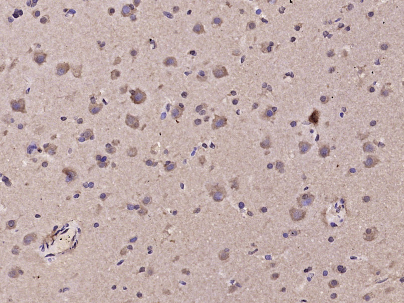 Paraformaldehyde-fixed, paraffin embedded Human brain glioma; Antigen retrieval by boiling in sodium citrate buffer (pH6.0) for 15min; Block endogenous peroxidase by 3% hydrogen peroxide for 20 minutes; Blocking buffer (normal goat serum) at 37°C for 30min; Antibody incubation with TRP12 Polyclonal Antibody, Unconjugated (bs-6425R) at 1:400 overnight at 4°C, DAB staining.