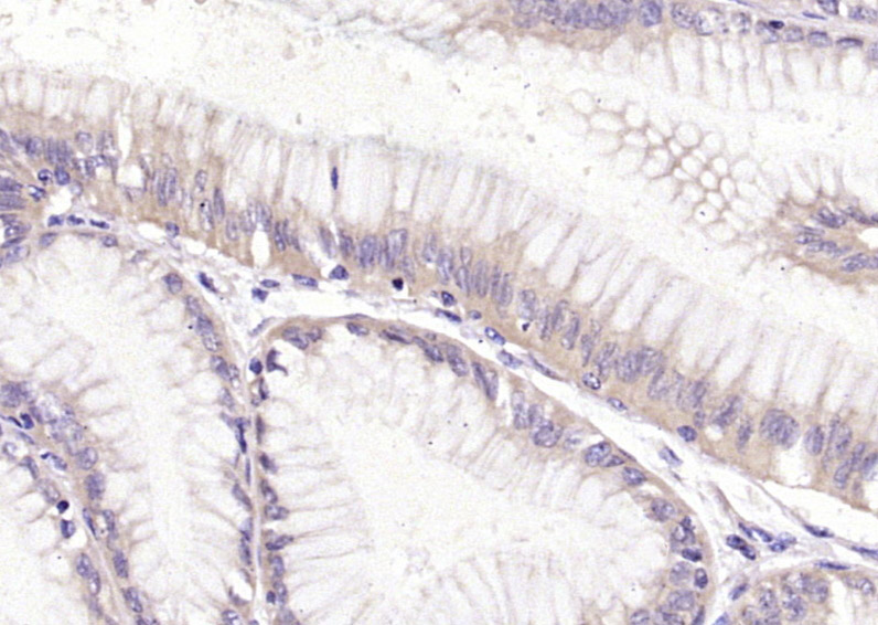 Paraformaldehyde-fixed, paraffin embedded Human gastric carcinoma; Antigen retrieval by boiling in sodium citrate buffer (pH6.0) for 15min; Block endogenous peroxidase by 3% hydrogen peroxide for 20 minutes; Blocking buffer (normal goat serum) at 37°C for 30min; Antibody incubation with HRH2 Polyclonal Antibody, Unconjugated (bs-6664R) at 1:400 overnight at 4°C, DAB staining.