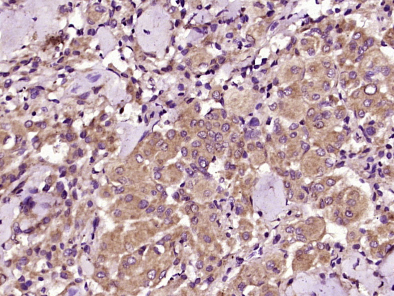 Paraformaldehyde-fixed, paraffin embedded Human meningiomas; Antigen retrieval by boiling in sodium citrate buffer (pH6.0) for 15min; Block endogenous peroxidase by 3% hydrogen peroxide for 20 minutes; Blocking buffer (normal goat serum) at 37°C for 30min; Antibody incubation with IGF2R Polyclonal Antibody, Unconjugated (bs-6670R) at 1:400 overnight at 4°C, DAB staining.
