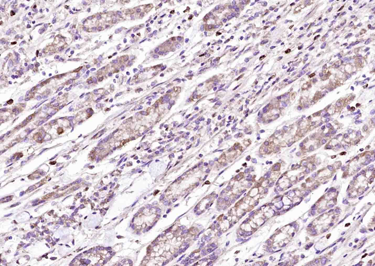 Paraformaldehyde-fixed, paraffin embedded Human gastric carcinoma; Antigen retrieval by boiling in sodium citrate buffer (pH6.0) for 15min; Block endogenous peroxidase by 3% hydrogen peroxide for 20 minutes; Blocking buffer (normal goat serum) at 37°C for 30min; Antibody incubation with Calpastatin Polyclonal Antibody, Unconjugated (bs-6701R) at 1:400 overnight at 4°C, DAB staining.