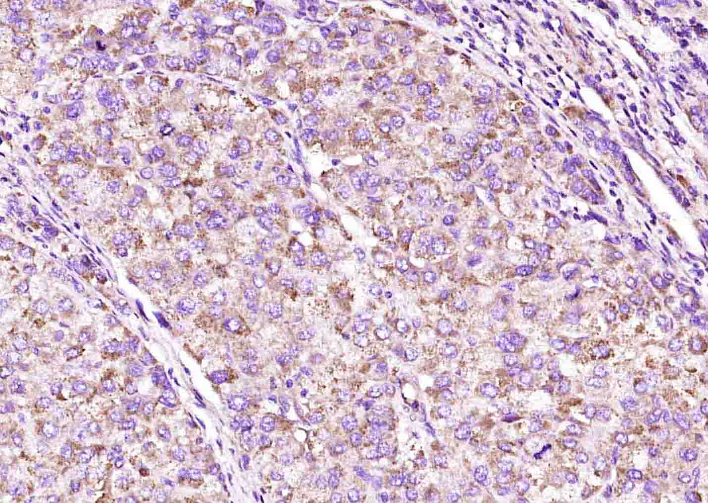 Paraformaldehyde-fixed, paraffin embedded Human liver cancer; Antigen retrieval by boiling in sodium citrate buffer (pH6.0) for 15min; Block endogenous peroxidase by 3% hydrogen peroxide for 20 minutes; Blocking buffer (normal goat serum) at 37°C for 30min; Antibody incubation with Calpastatin Polyclonal Antibody, Unconjugated (bs-6701R) at 1:400 overnight at 4°C, DAB staining.