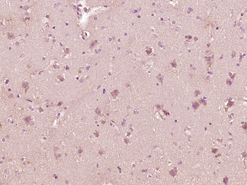 Paraformaldehyde-fixed, paraffin embedded Human brain glioma; Antigen retrieval by boiling in sodium citrate buffer (pH6.0) for 15min; Block endogenous peroxidase by 3% hydrogen peroxide for 20 minutes; Blocking buffer (normal goat serum) at 37°C for 30min; Antibody incubation with RAB7 Polyclonal Antibody, Unconjugated (bs-6703R) at 1:400 overnight at 4°C, DAB staining.
