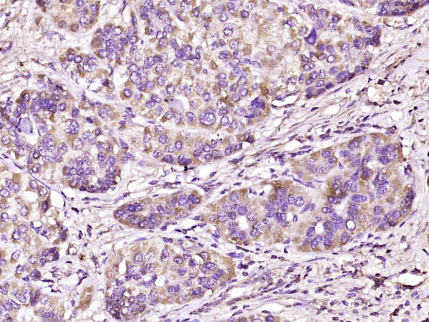 Paraformaldehyde-fixed, paraffin embedded Human liver cancer; Antigen retrieval by boiling in sodium citrate buffer (pH6.0) for 15min; Block endogenous peroxidase by 3% hydrogen peroxide for 20 minutes; Blocking buffer (normal goat serum) at 37°C for 30min; Antibody incubation with SEMA4A Polyclonal Antibody, Unconjugated (bs-7519R) at 1:400 overnight at 4°C, DAB staining.