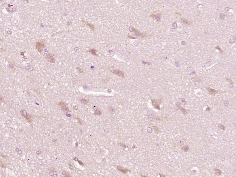 Paraformaldehyde-fixed, paraffin embedded Human brain glioma; Antigen retrieval by boiling in sodium citrate buffer (pH6.0) for 15min; Block endogenous peroxidase by 3% hydrogen peroxide for 20 minutes; Blocking buffer (normal goat serum) at 37°C for 30min; Antibody incubation with FAM150A Polyclonal Antibody, Unconjugated (bs-8219R) at 1:400 overnight at 4°C, DAB staining.