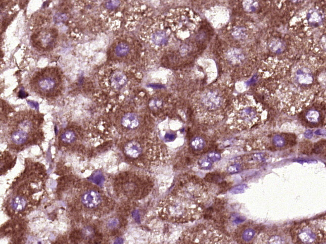 Paraformaldehyde-fixed, paraffin embedded Human liver cancer; Antigen retrieval by boiling in sodium citrate buffer (pH6.0) for 15min; Block endogenous peroxidase by 3% hydrogen peroxide for 20 minutes; Blocking buffer (normal goat serum) at 37°C for 30min; Antibody incubation with BTBD17 Polyclonal Antibody, Unconjugated (bs-8400R) at 1:400 overnight at 4°C, DAB staining.