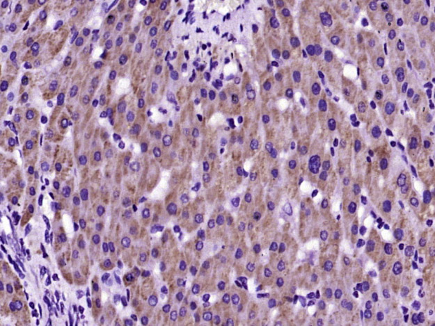 Paraformaldehyde-fixed, paraffin embedded Human liver; Antigen retrieval by boiling in sodium citrate buffer (pH6.0) for 15min; Block endogenous peroxidase by 3% hydrogen peroxide for 20 minutes; Blocking buffer (normal goat serum) at 37°C for 30min; Antibody incubation with SARM1 Polyclonal Antibody, Unconjugated (bs-9001R) at 1:400 overnight at 4°C, DAB staining.