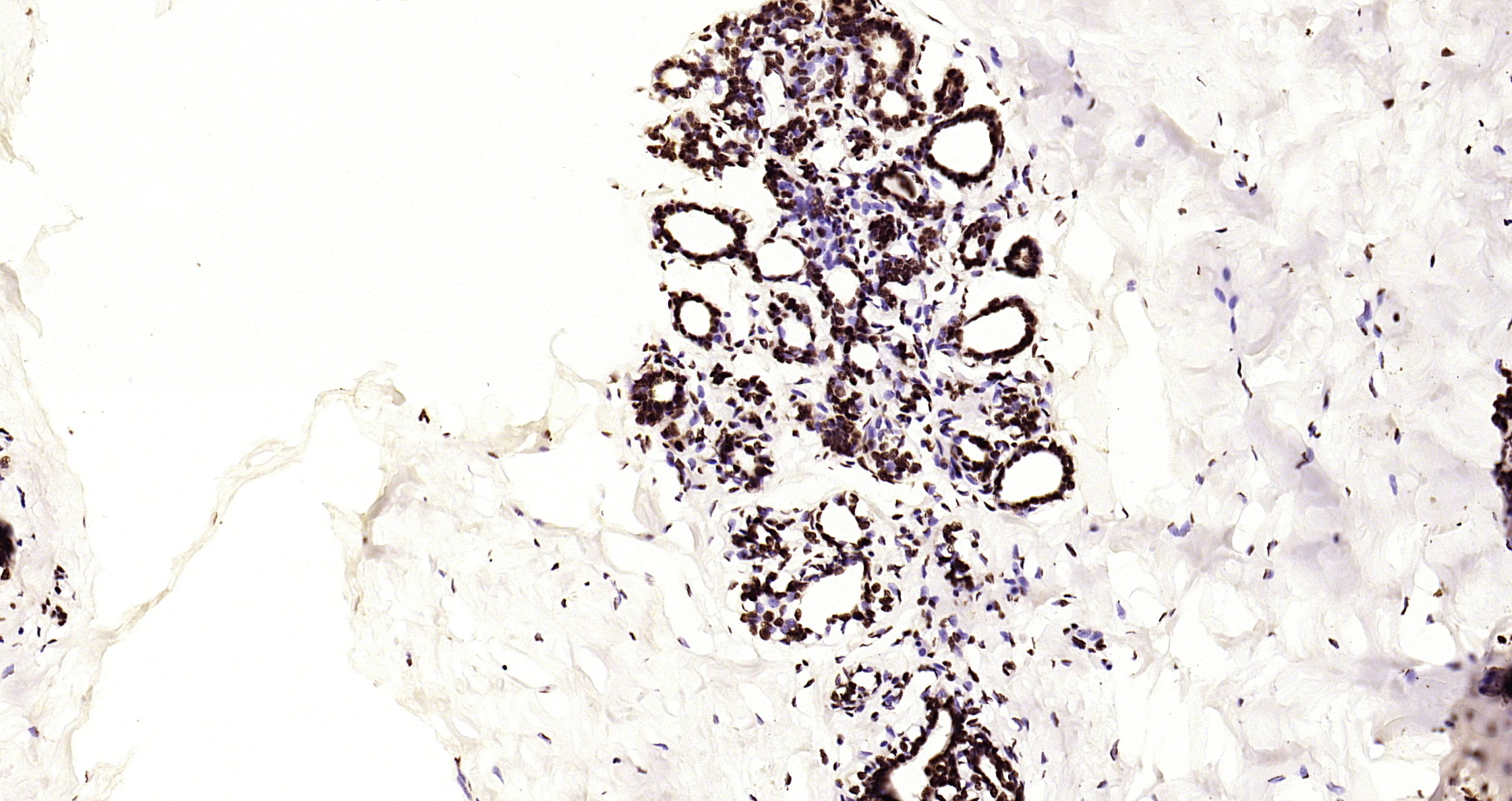 Paraformaldehyde-fixed, paraffin embedded Human breast; Antigen retrieval by boiling in sodium citrate buffer (pH6.0) for 15min; Block endogenous peroxidase by 3% hydrogen peroxide for 20 minutes; Blocking buffer (normal goat serum) at 37°C for 30min; Antibody incubation with Histone H3(di methyl K79) Monoclonal Antibody, Unconjugated (bsm-33123M) at 1:200 overnight at 4°C, DAB staining.