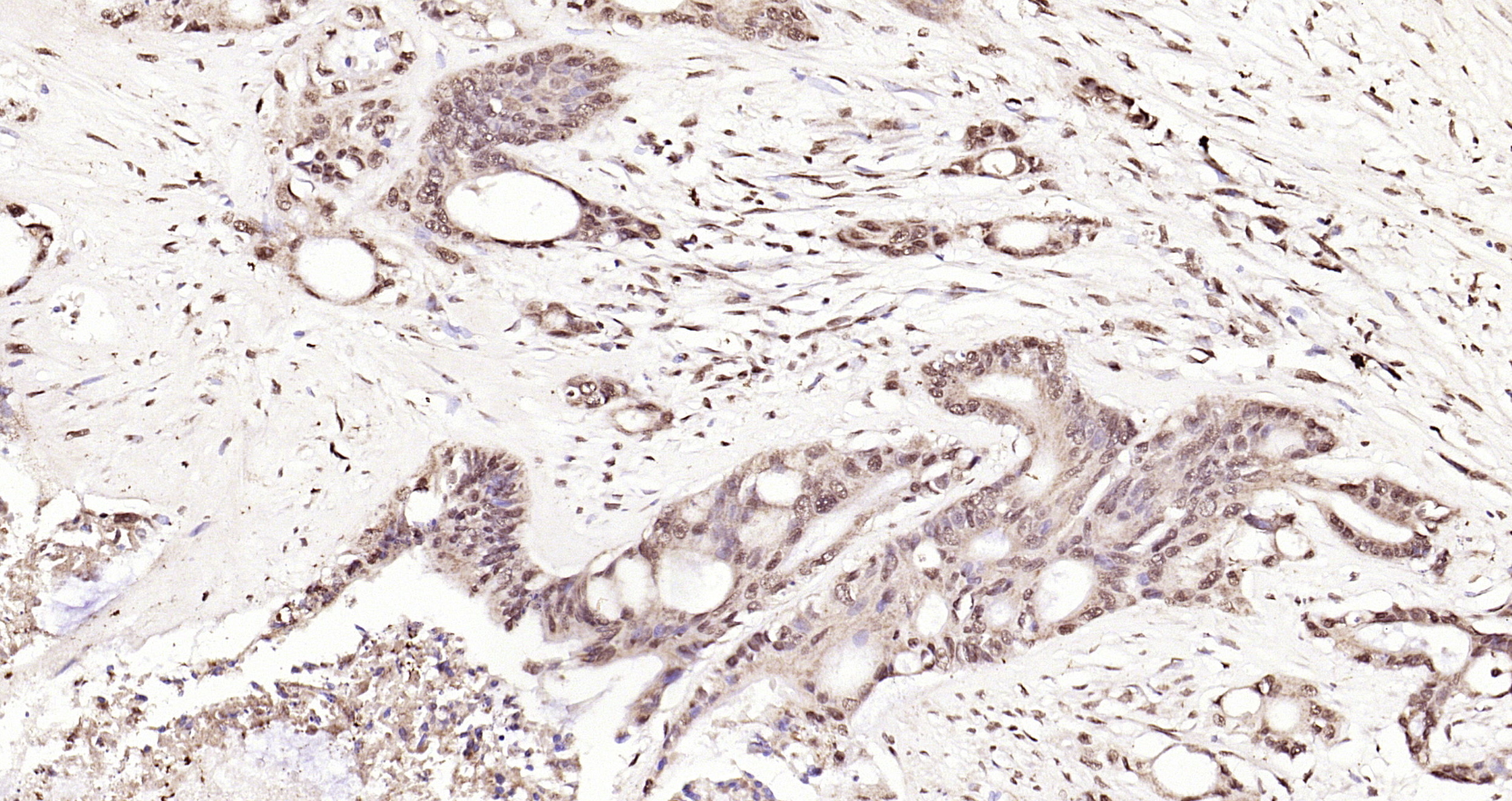 Paraformaldehyde-fixed, paraffin embedded Human cervical cancer; Antigen retrieval by boiling in sodium citrate buffer (pH6.0) for 15min; Block endogenous peroxidase by 3% hydrogen peroxide for 20 minutes; Blocking buffer (normal goat serum) at 37°C for 30min; Antibody incubation with CDKN1A (Thr145) Polyclonal Antibody, Unconjugated (bs-5237R) at 1:200 overnight at 4°C, DAB staining.