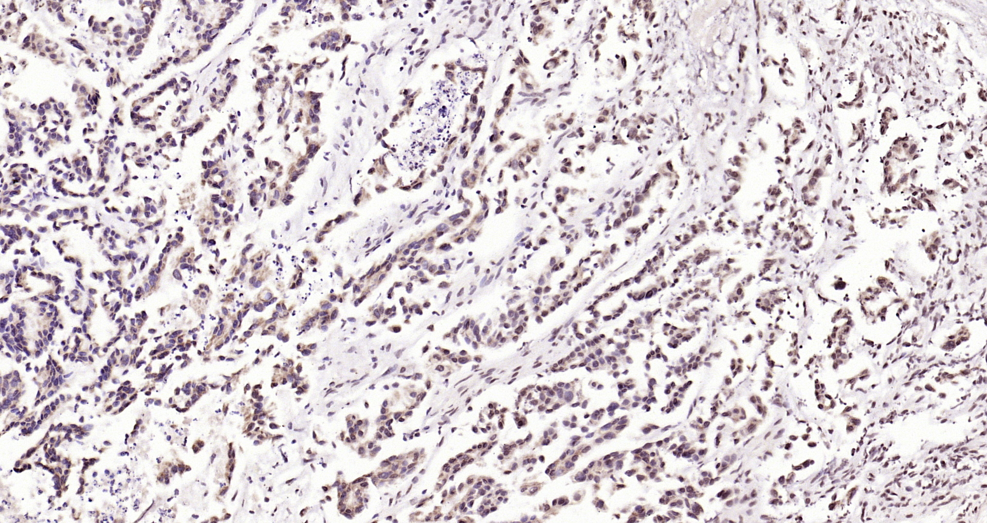 Paraformaldehyde-fixed, paraffin embedded Human gastric carcinoma; Antigen retrieval by boiling in sodium citrate buffer (pH6.0) for 15min; Block endogenous peroxidase by 3% hydrogen peroxide for 20 minutes; Blocking buffer (normal goat serum) at 37°C for 30min; Antibody incubation with CDKN1A (Thr145) Polyclonal Antibody, Unconjugated (bs-5237R) at 1:200 overnight at 4°C, DAB staining.