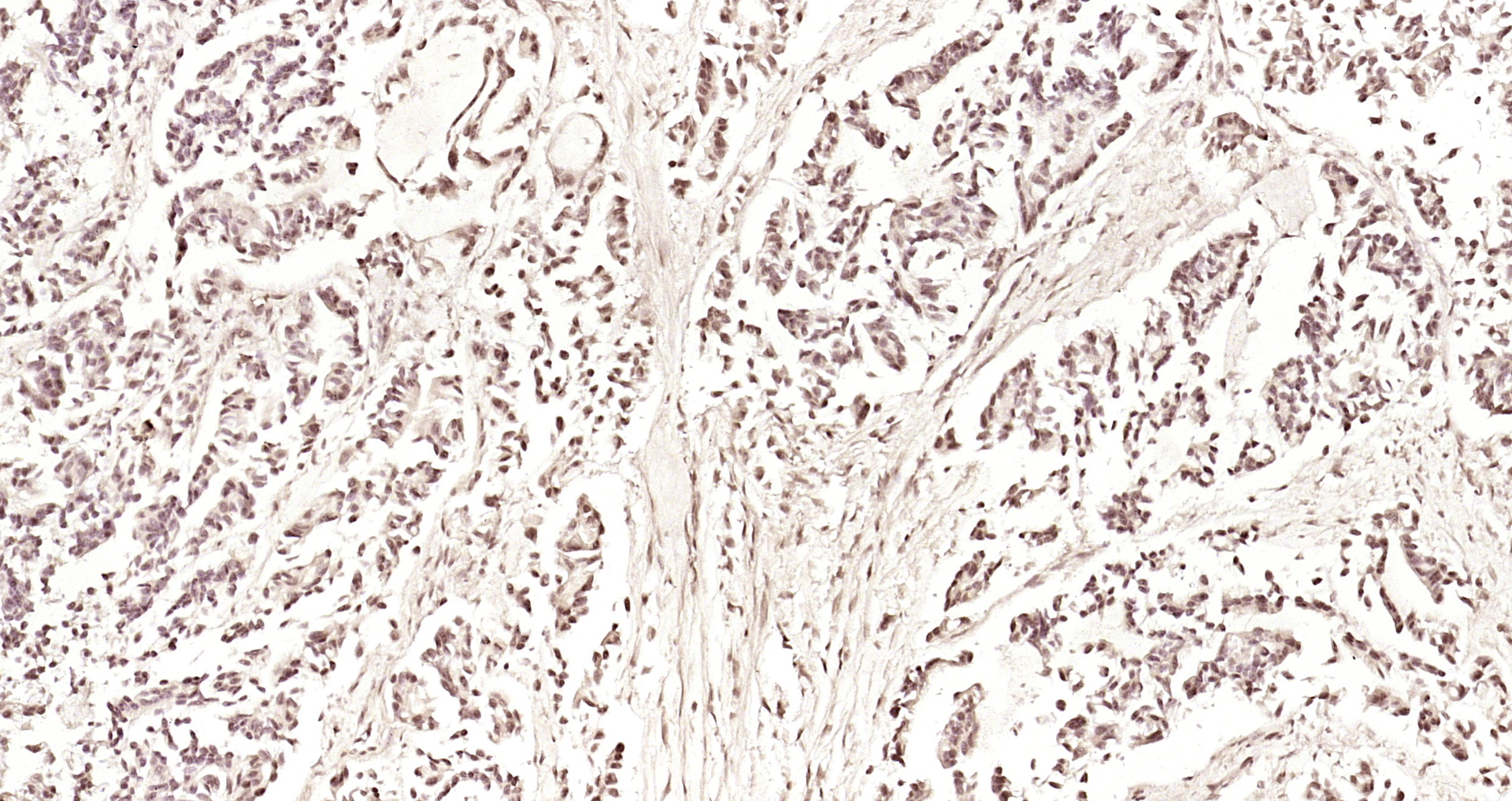 Paraformaldehyde-fixed, paraffin embedded Human gastric carcinoma; Antigen retrieval by boiling in sodium citrate buffer (pH6.0) for 15min; Block endogenous peroxidase by 3% hydrogen peroxide for 20 minutes; Blocking buffer (normal goat serum) at 37°C for 30min; Antibody incubation with PIK3R5 Polyclonal Antibody, Unconjugated (bs-7467R) at 1:200 overnight at 4°C, DAB staining.