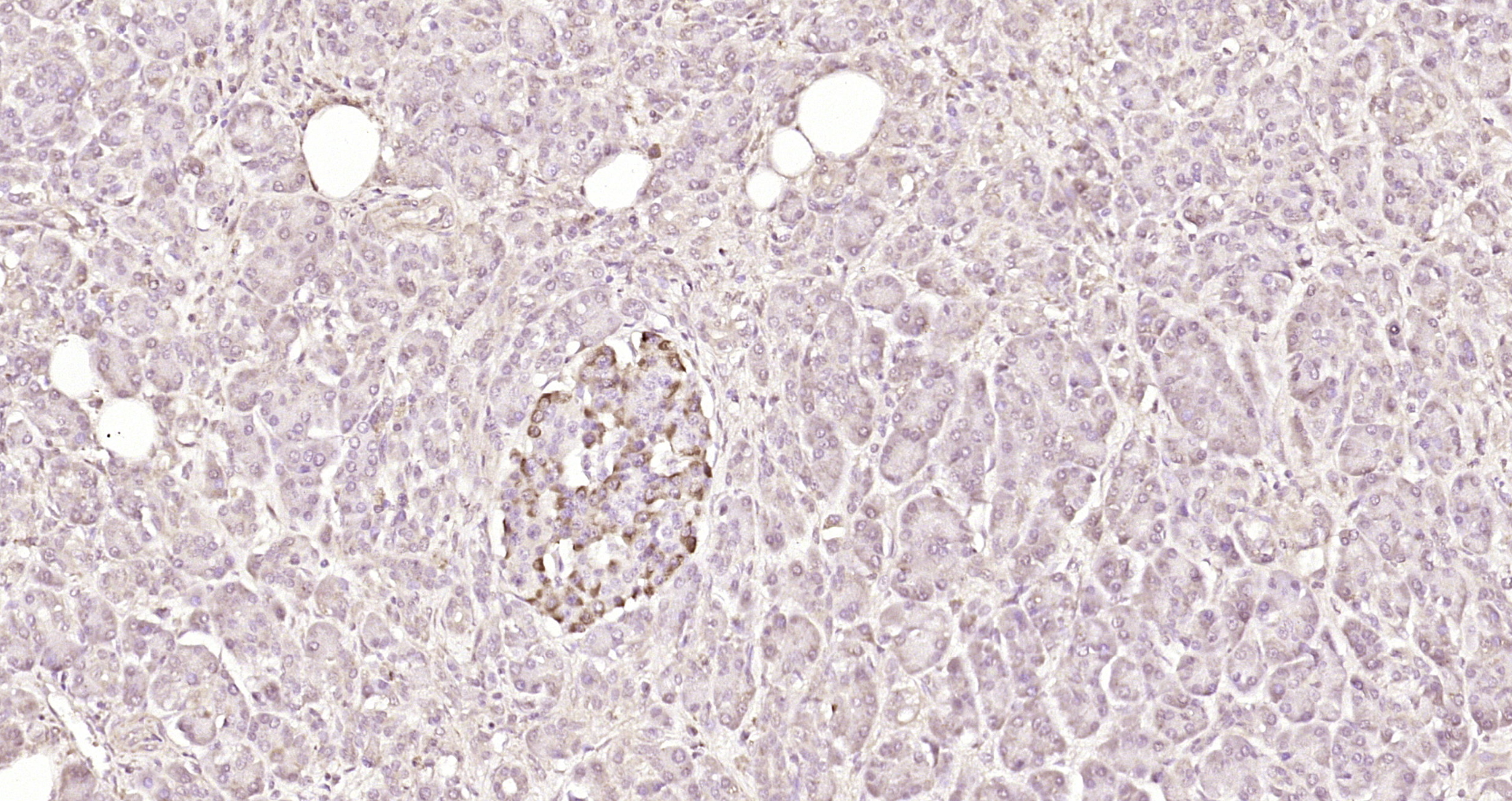 Paraformaldehyde-fixed, paraffin embedded Human pancreatic cancer; Antigen retrieval by boiling in sodium citrate buffer (pH6.0) for 15min; Block endogenous peroxidase by 3% hydrogen peroxide for 20 minutes; Blocking buffer (normal goat serum) at 37°C for 30min; Antibody incubation with PIK3R5 Polyclonal Antibody, Unconjugated (bs-7467R) at 1:200 overnight at 4°C, DAB staining. Paraformaldehyde-fixed, paraffin embedded Human pancreatic cancer; Antigen retrieval by boiling in sodium citrate buffer (pH6.0) for 15min; Block endogenous peroxidase by 3% hydrogen peroxide for 20 minutes; Blocking buffer (normal goat serum) at 37°C for 30min; Antibody incubation with PIK3R5 Polyclonal Antibody, Unconjugated (bs-7467R) at 1:200 overnight at 4°C, DAB staining.