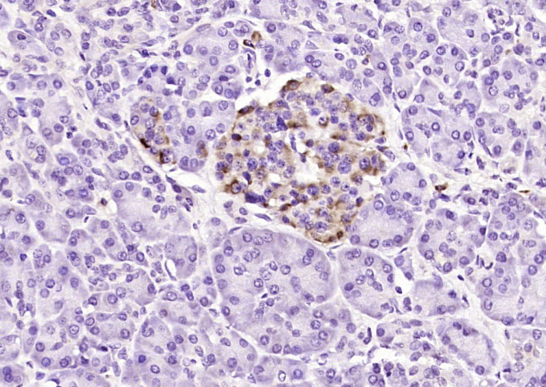 Paraformaldehyde-fixed, paraffin embedded Human pancreatic cancer; Antigen retrieval by boiling in sodium citrate buffer (pH6.0) for 15min; Block endogenous peroxidase by 3% hydrogen peroxide for 20 minutes; Blocking buffer (normal goat serum) at 37°C for 30min; Antibody incubation with Phospholipase D2 Polyclonal Antibody, Unconjugated (bs-8747R) at 1:200 overnight at 4°C, DAB staining.