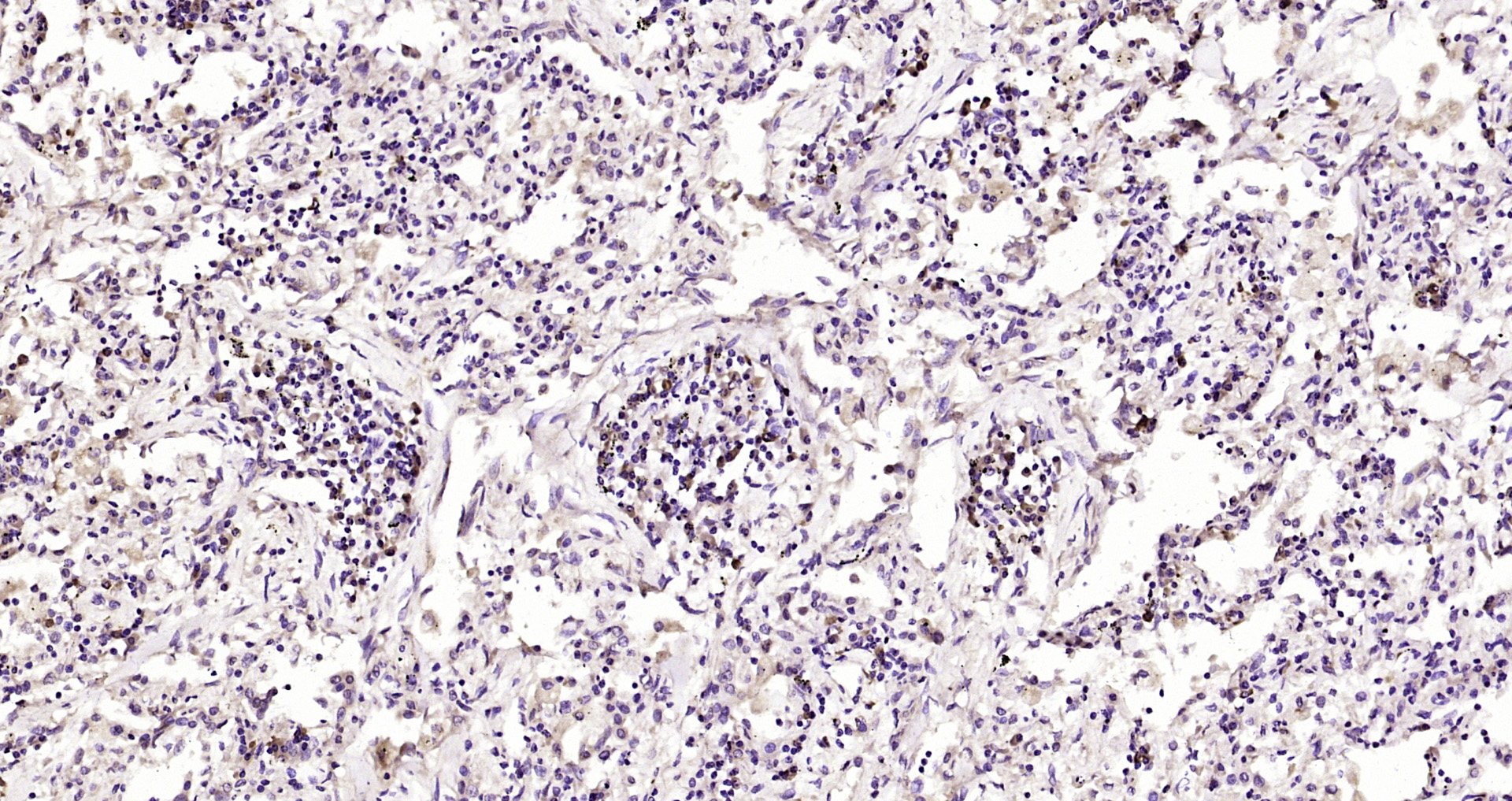 Paraformaldehyde-fixed, paraffin embedded Human lung cancer; Antigen retrieval by boiling in sodium citrate buffer (pH6.0) for 15min; Block endogenous peroxidase by 3% hydrogen peroxide for 20 minutes; Blocking buffer (normal goat serum) at 37°C for 30min; Antibody incubation with CTR1 Polyclonal Antibody, Unconjugated (bs-10773R) at 1:200 overnight at 4°C, DAB staining.