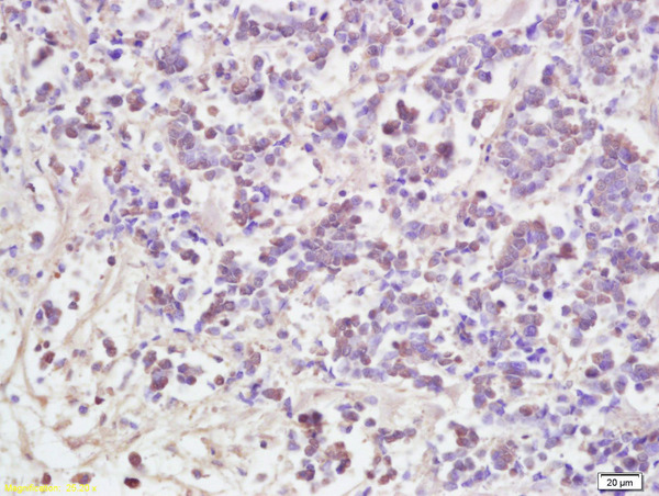 Formalin-fixed and paraffin embedded human lung carcinoma labeled with Anti AATF Polyclonal Antibody, Unconjugated (bs-1229R ) at 1:200 followed by conjugation to the secondary antibody and DAB staining