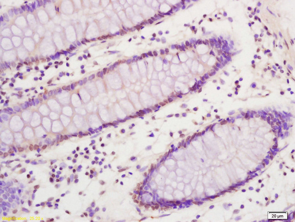 Formalin-fixed and paraffin embedded human colon carcinoma labeled with Anti SREBP-1 Polyclonal Antibody, Unconjugated (bs-1402R) at 1:200 followed by conjugation to the secondary antibody and DAB staining
