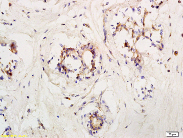 Formalin-fixed and paraffin embedded human breast carcinoma labeled with Anti LIFR/CD118 Polyclonal Antibody, Unconjugated (bs-1458R) at 1:200 followed by conjugation to the secondary antibody and DAB staining Formalin-fixed and paraffin embedded human breast carcinoma labeled with Anti LIFR/CD118 Polyclonal Antibody, Unconjugated (bs-1458R) at 1:200 followed by conjugation to the secondary antibody and DAB staining