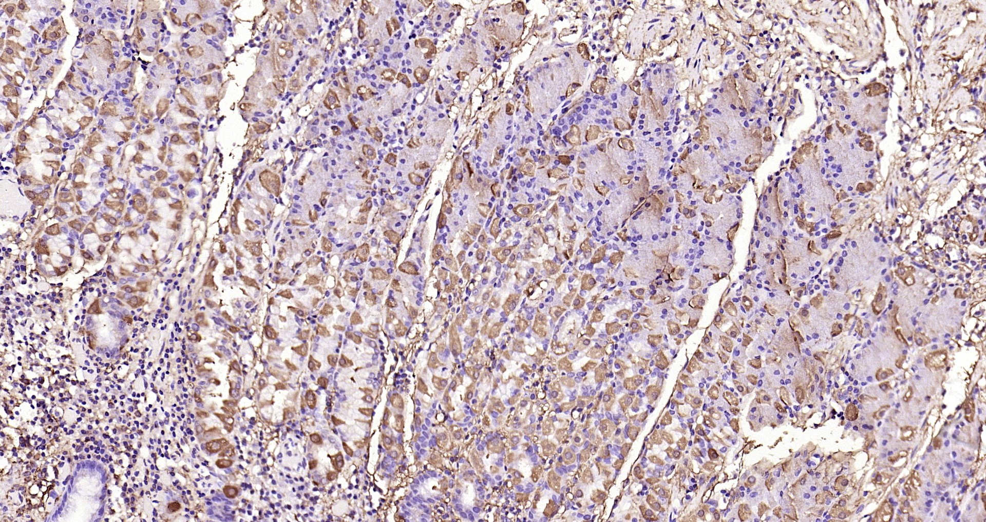 Paraformaldehyde-fixed, paraffin embedded Human gastric carcinoma; Antigen retrieval by boiling in sodium citrate buffer (pH6.0) for 15min; Block endogenous peroxidase by 3% hydrogen peroxide for 20 minutes; Blocking buffer (normal goat serum) at 37°C for 30min; Antibody incubation with MMP-1 Polyclonal Antibody, Unconjugated (bs-4597R) at 1:200 overnight at 4°C, DAB staining.