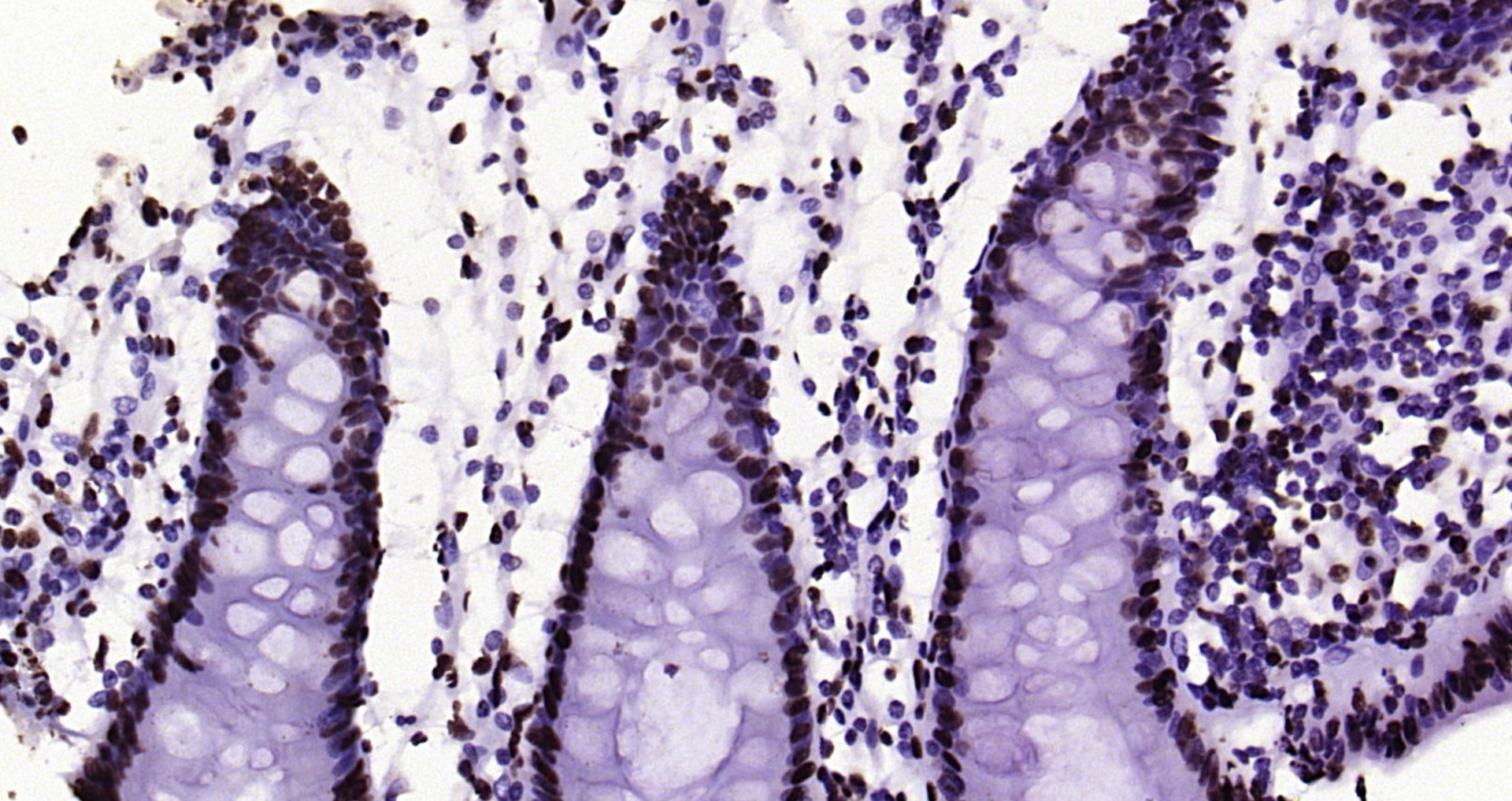 Paraformaldehyde-fixed, paraffin embedded Human colon; Antigen retrieval by boiling in sodium citrate buffer (pH6.0) for 15min; Block endogenous peroxidase by 3% hydrogen peroxide for 20 minutes; Blocking buffer (normal goat serum) at 37°C for 30min; Antibody incubation with Histone H3 (tri methyl K79) Monoclonal Antibody, Unconjugated (bsm-33097M) at 1:200 overnight at 4°C, DAB staining.