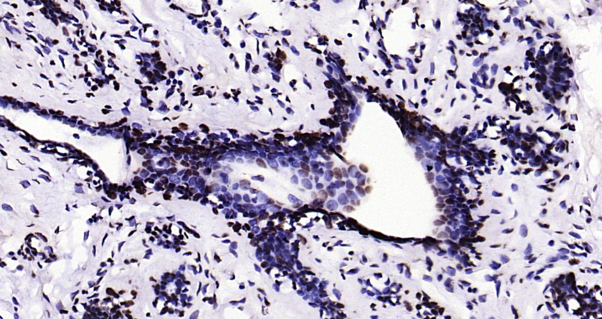 Paraformaldehyde-fixed, paraffin embedded Human breast; Antigen retrieval by boiling in sodium citrate buffer (pH6.0) for 15min; Block endogenous peroxidase by 3% hydrogen peroxide for 20 minutes; Blocking buffer (normal goat serum) at 37°C for 30min; Antibody incubation with Histone H3 (tri methyl K79) Monoclonal Antibody, Unconjugated (bsm-33097M) at 1:200 overnight at 4°C, DAB staining.