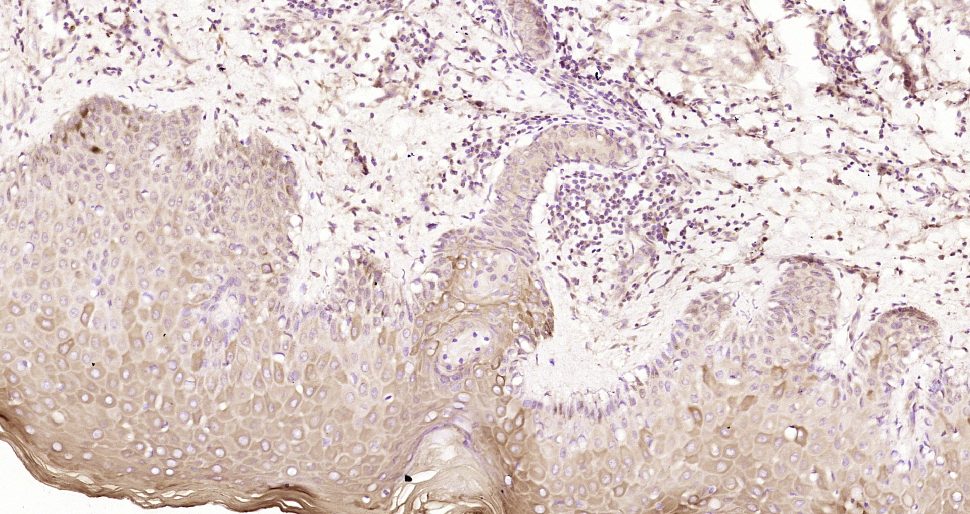 Paraformaldehyde-fixed, paraffin embedded Human skin cancer; Antigen retrieval by boiling in sodium citrate buffer (pH6.0) for 15min; Block endogenous peroxidase by 3% hydrogen peroxide for 20 minutes; Blocking buffer (normal goat serum) at 37°C for 30min; Antibody incubation with Ataxin 3 Polyclonal Antibody, Unconjugated (bs-17208R) at 1:200 overnight at 4°C, DAB staining.