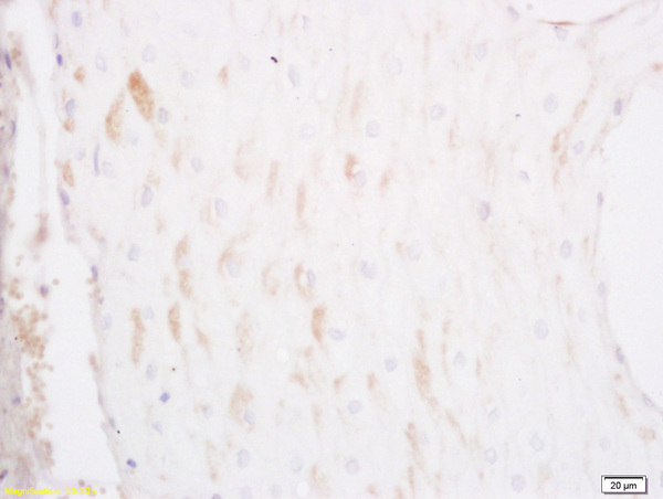 Formalin-fixed and paraffin embedded human esophageal carcinoma labeled with Anti APOLLON/BIRC6 Polyclonal Antibody, Unconjugated (bs-1489R) at 1:200 followed by conjugation to the secondary antibody and DAB staining