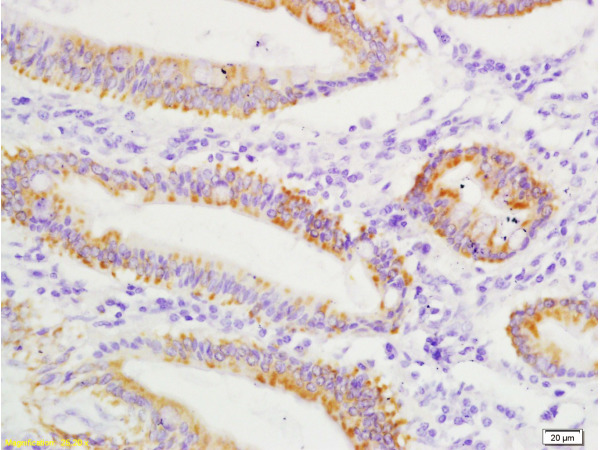 Formalin-fixed and paraffin embedded human colon carcinoma labeled with Anti SLC4A7/NBCN1 Polyclonal Antibody, Unconjugated (bs-1530R) at 1:200 followed by conjugation to the secondary antibody and DAB staining