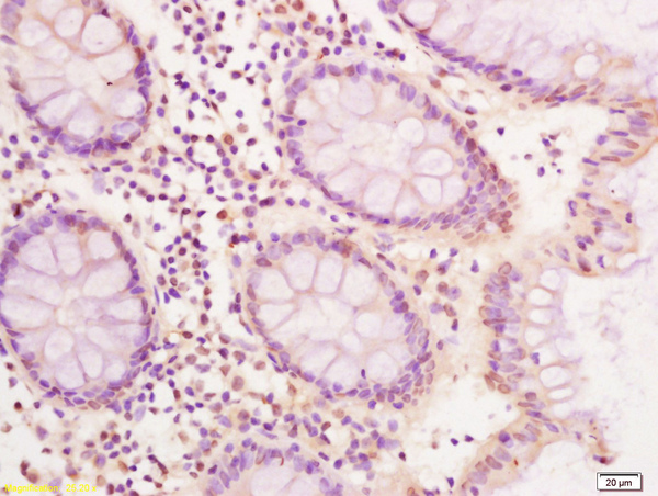 Formalin-fixed and paraffin embedded human colon carcinoma labeled with Anti CDX2 Polyclonal Antibody, Unconjugated (bs-1620R) at 1:200 followed by conjugation to the secondary antibody and DAB staining