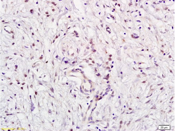 Formalin-fixed and paraffin embedded human gastric carcinoma labeled with Anti E2F5 Polyclonal Antibody, Unconjugated (bs-1734R) at 1:200 followed by conjugation to the secondary antibody and DAB staining Formalin-fixed and paraffin embedded human gastric carcinoma labeled with Anti E2F5 Polyclonal Antibody, Unconjugated (bs-1734R) at 1:200 followed by conjugation to the secondary antibody and DAB staining