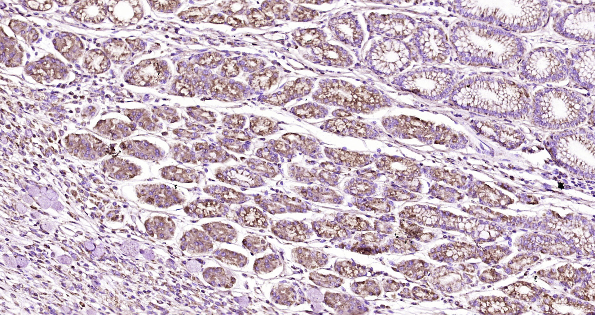 Paraformaldehyde-fixed, paraffin embedded Human gastric carcinoma; Antigen retrieval by boiling in sodium citrate buffer (pH6.0) for 15min; Block endogenous peroxidase by 3% hydrogen peroxide for 20 minutes; Blocking buffer (normal goat serum) at 37°C for 30min; Antibody incubation with PRKD1/PKC mu Polyclonal Antibody, Unconjugated (bs-21780R) at 1:200 overnight at 4°C, DAB staining.
