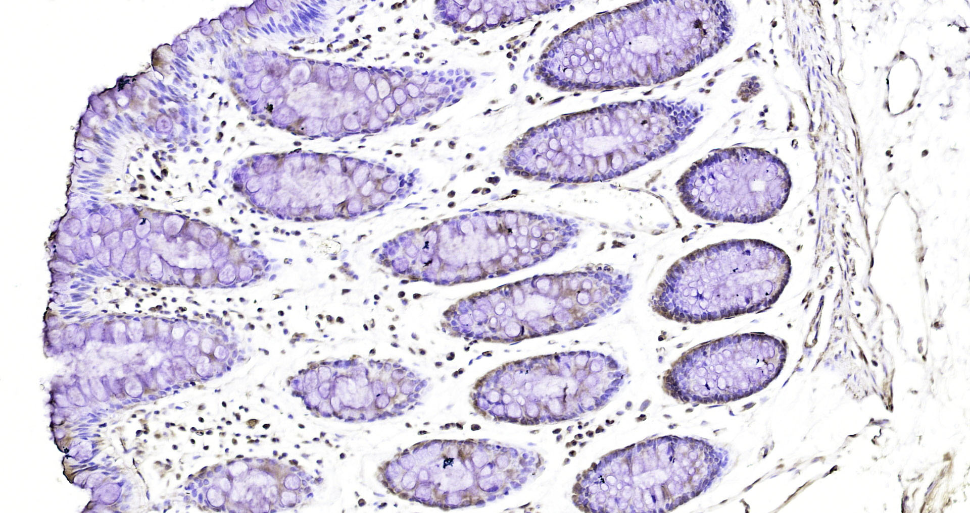 Paraformaldehyde-fixed, paraffin embedded Human colon cancer; Antigen retrieval by boiling in sodium citrate buffer (pH6.0) for 15min; Block endogenous peroxidase by 3% hydrogen peroxide for 20 minutes; Blocking buffer (normal goat serum) at 37°C for 30min; Antibody incubation with OSMR Polyclonal Antibody, Unconjugated (bs-21823R) at 1:200 overnight at 4°C, DAB staining.