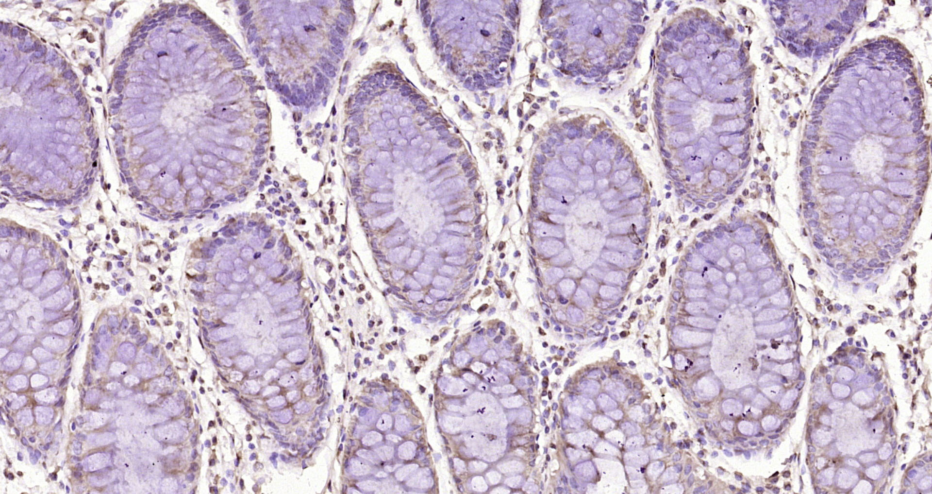 Paraformaldehyde-fixed, paraffin embedded Human colon cancer; Antigen retrieval by boiling in sodium citrate buffer (pH6.0) for 15min; Block endogenous peroxidase by 3% hydrogen peroxide for 20 minutes; Blocking buffer (normal goat serum) at 37°C for 30min; Antibody incubation with CD163L1 Polyclonal Antibody, Unconjugated (bs-21936R) at 1:200 overnight at 4°C, DAB staining.