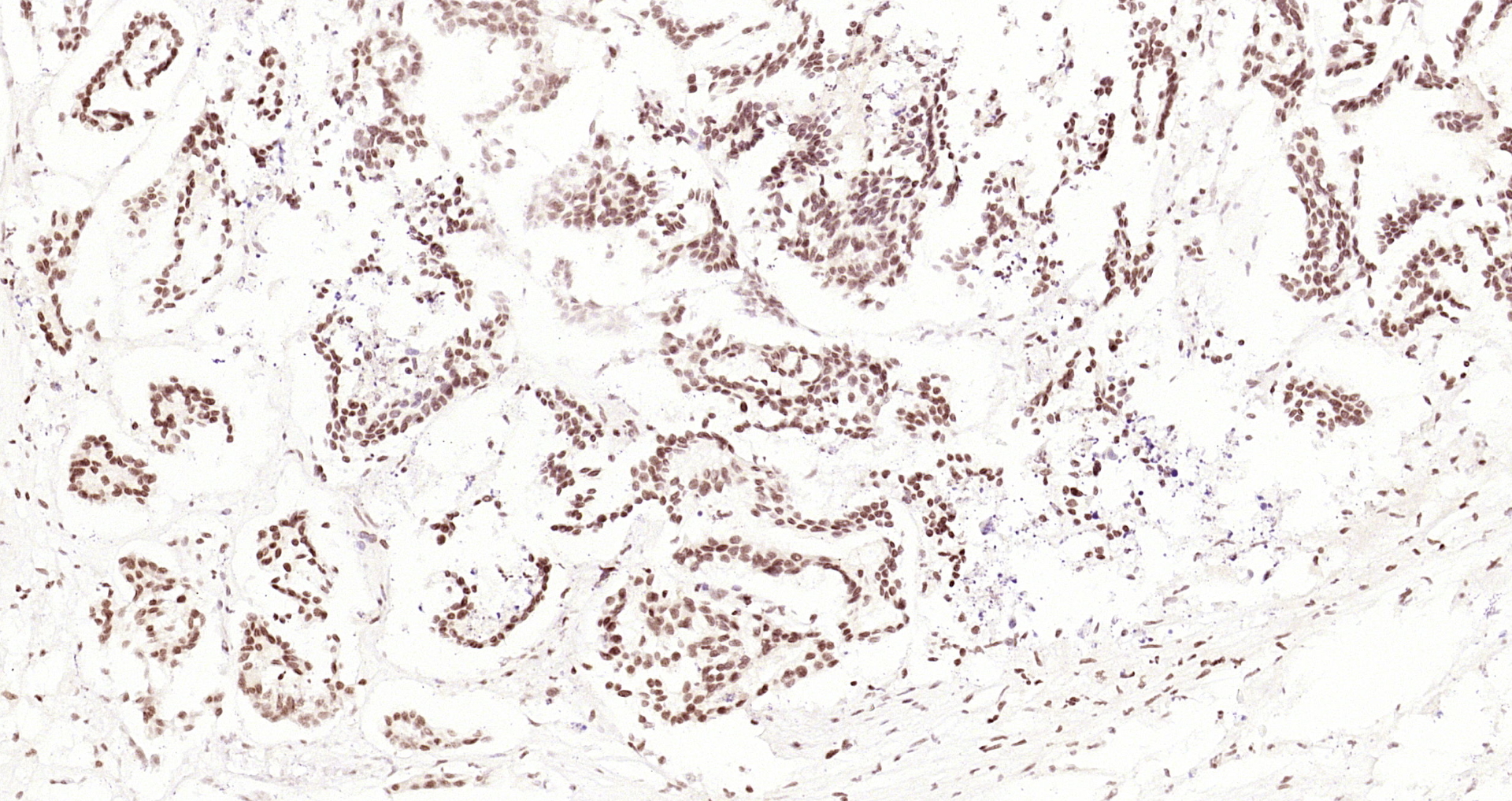 Paraformaldehyde-fixed, paraffin embedded Human gastric carcinoma; Antigen retrieval by boiling in sodium citrate buffer (pH6.0) for 15min; Block endogenous peroxidase by 3% hydrogen peroxide for 20 minutes; Blocking buffer (normal goat serum) at 37°C for 30min; Antibody incubation with CDCA7 Polyclonal Antibody, Unconjugated (bs-22227R) at 1:200 overnight at 4°C, DAB staining.