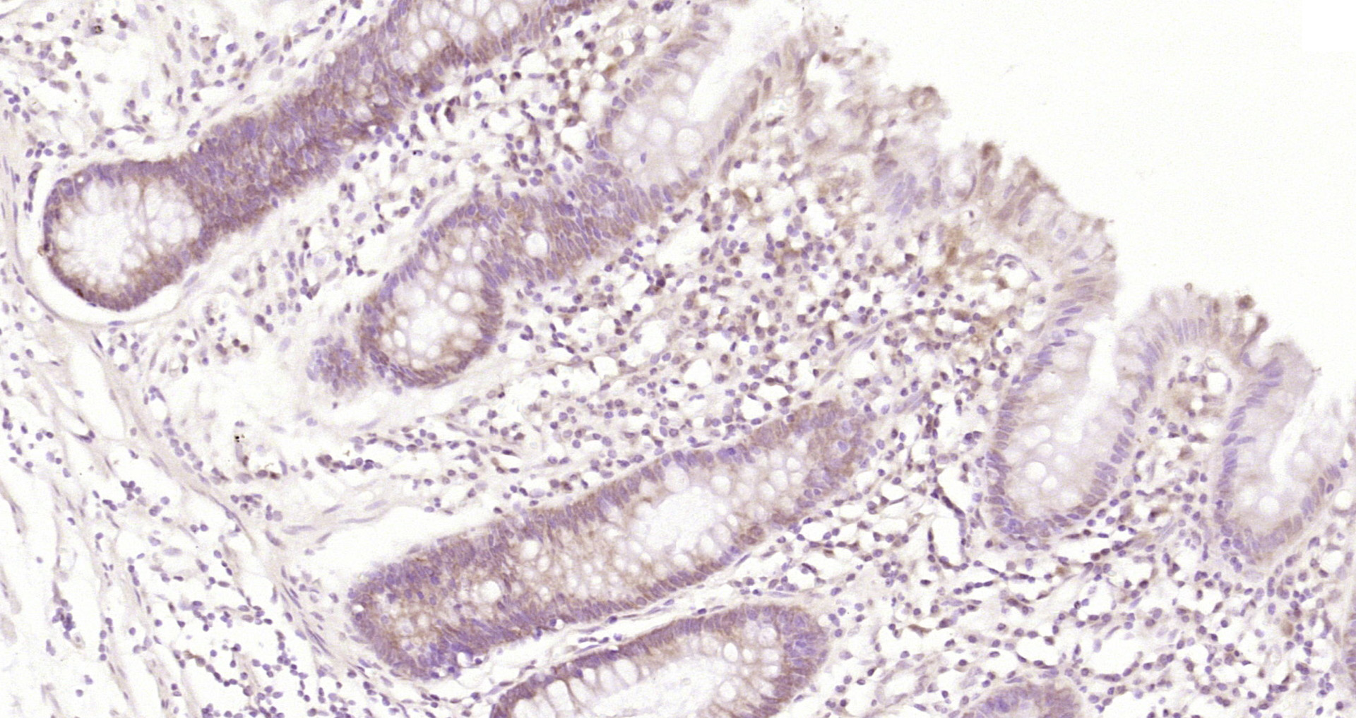 Paraformaldehyde-fixed, paraffin embedded Human rectal cancer; Antigen retrieval by boiling in sodium citrate buffer (pH6.0) for 15min; Block endogenous peroxidase by 3% hydrogen peroxide for 20 minutes; Blocking buffer (normal goat serum) at 37°C for 30min; Antibody incubation with CTNND2/delta 2 Catenin Polyclonal Antibody, Unconjugated (bs-22251R) at 1:200 overnight at 4°C, DAB staining.
