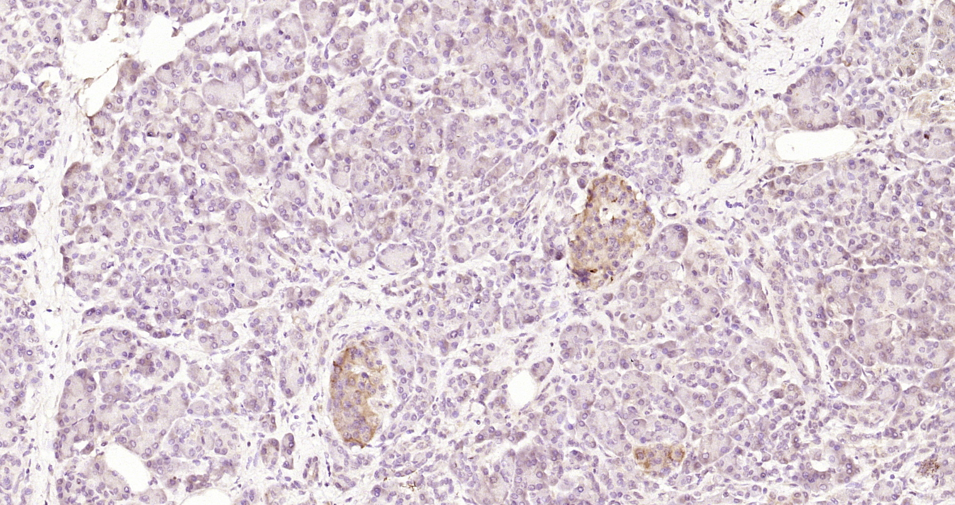 Paraformaldehyde-fixed, paraffin embedded Human pancreatic cancer; Antigen retrieval by boiling in sodium citrate buffer (pH6.0) for 15min; Block endogenous peroxidase by 3% hydrogen peroxide for 20 minutes; Blocking buffer (normal goat serum) at 37°C for 30min; Antibody incubation with CD151 Polyclonal Antibody, Unconjugated (bs-22290R) at 1:200 overnight at 4°C, DAB staining.