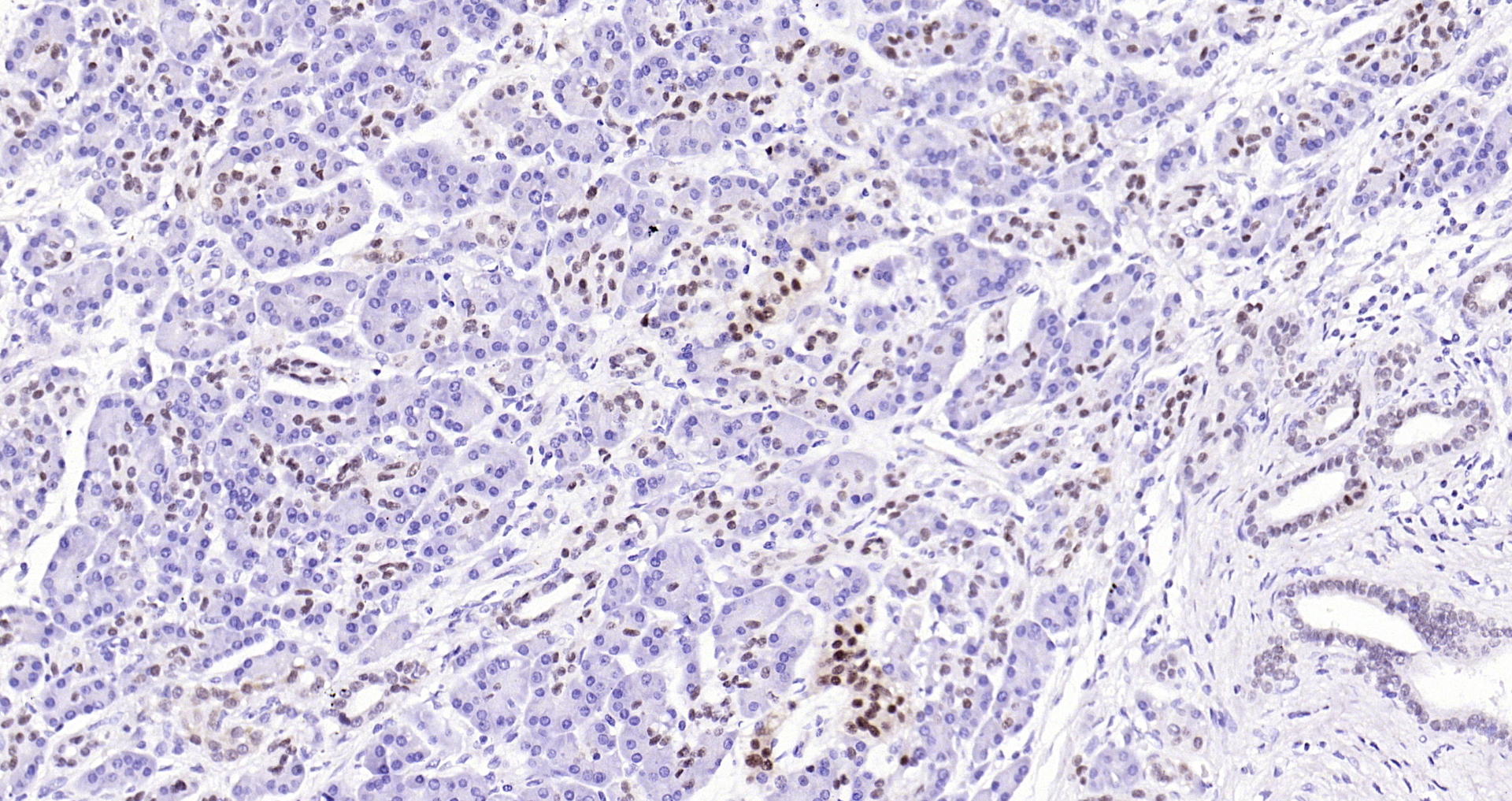 Paraformaldehyde-fixed, paraffin embedded Human pancreatic cancer; Antigen retrieval by boiling in sodium citrate buffer (pH6.0) for 15min; Block endogenous peroxidase by 3% hydrogen peroxide for 20 minutes; Blocking buffer (normal goat serum) at 37°C for 30min; Antibody incubation with PDX1 (34A1) Monoclonal Antibody, Unconjugated (bsm-54153R) at 1:200 overnight at 4°C, DAB staining.