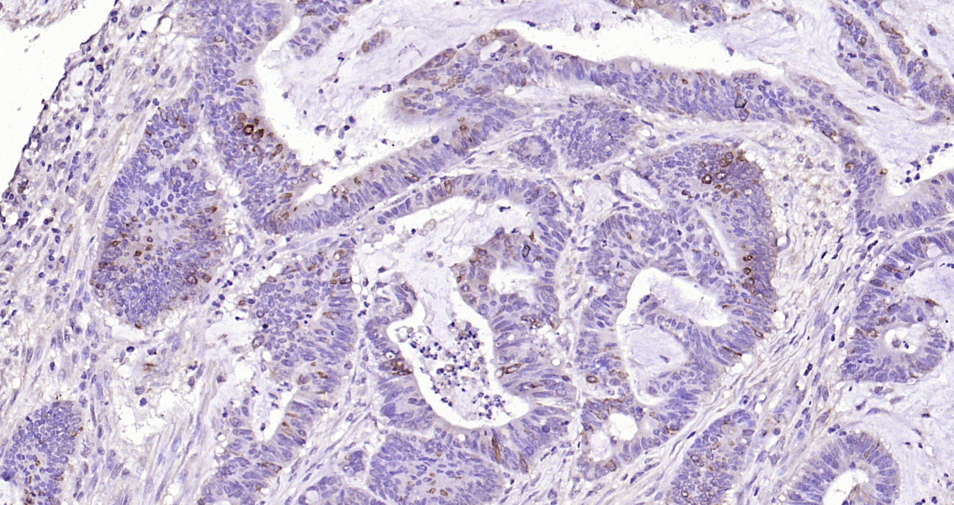 Paraformaldehyde-fixed, paraffin embedded Human colon cancer; Antigen retrieval by boiling in sodium citrate buffer (pH6.0) for 15min; Block endogenous peroxidase by 3% hydrogen peroxide for 20 minutes; Blocking buffer (normal goat serum) at 37°C for 30min; Antibody incubation with IL-13Ra2 Polyclonal Antibody, Unconjugated (bs-22785R) at 1:200 overnight at 4°C, DAB staining.