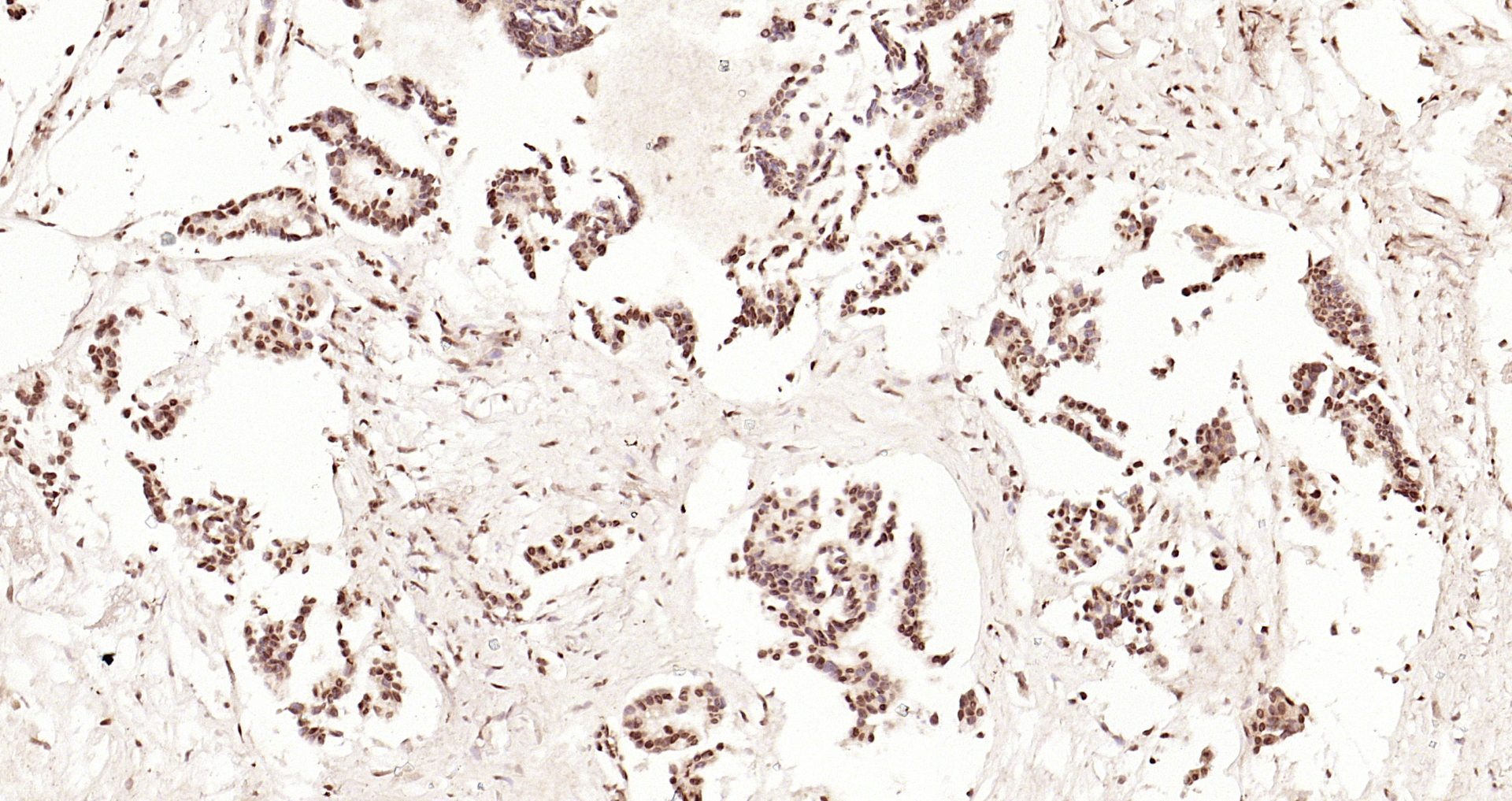 Paraformaldehyde-fixed, paraffin embedded Human gastric carcinoma; Antigen retrieval by boiling in sodium citrate buffer (pH6.0) for 15min; Block endogenous peroxidase by 3% hydrogen peroxide for 20 minutes; Blocking buffer (normal goat serum) at 37°C for 30min; Antibody incubation with CDKN1A/p21 Polyclonal Antibody, Unconjugated (bs-22795R) at 1:200 overnight at 4°C, DAB staining.