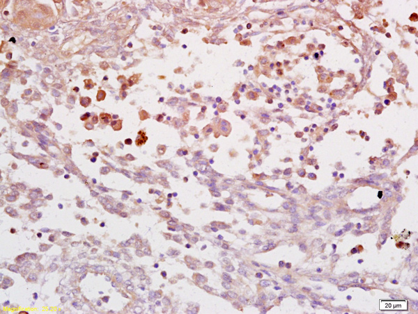 Formalin-fixed and paraffin embedded human endometrial carcinoma labeled with Anti IL-6R alpha\/IL-6 receptor \u03b1 Polyclonal Antibody, Unconjugated (bs-1805R) at 1:200 followed by conjugation to the secondary antibody and DAB staining