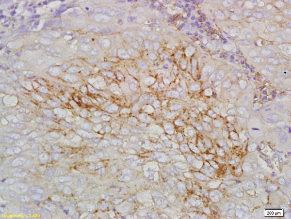 Formalin-fixed and paraffin embedded human laryngocarcinoma labeled with Anti STEAP1 Polyclonal Antibody, Unconjugated (bs-1901R) at 1:200 followed by conjugation to the secondary antibody and DAB staining