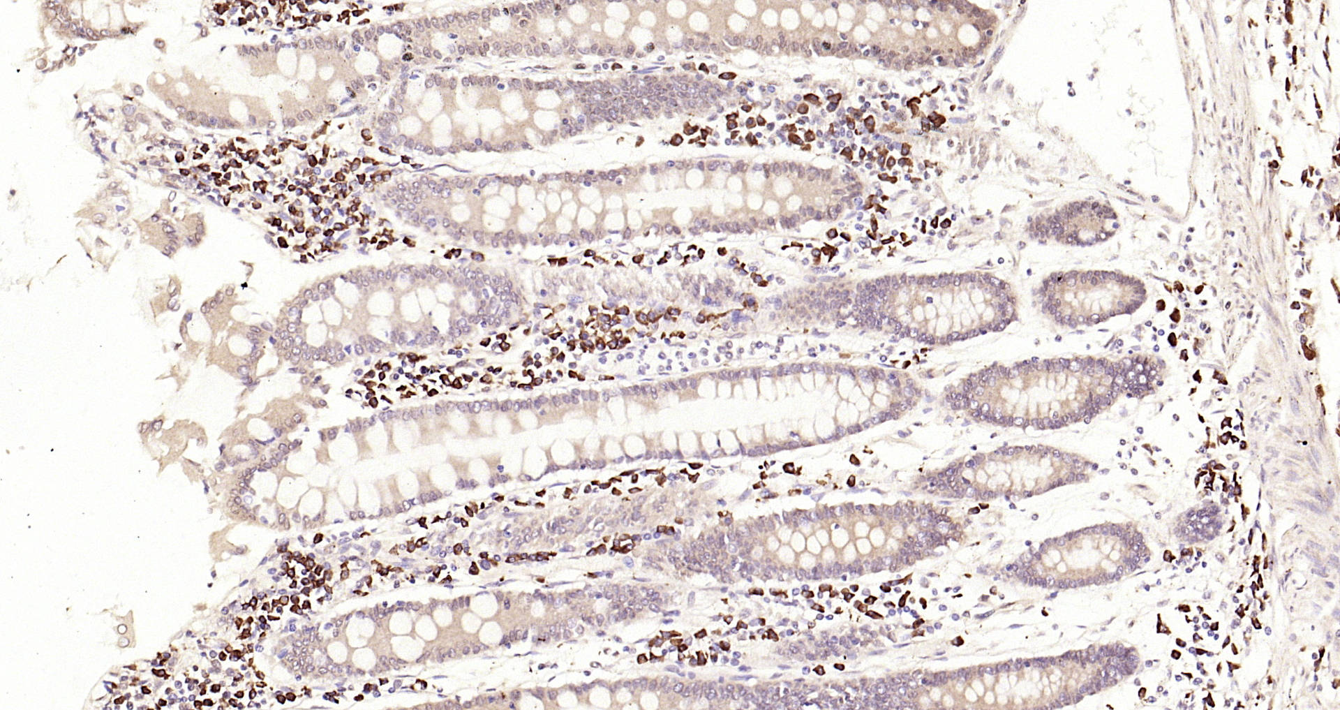 Paraformaldehyde-fixed, paraffin embedded Human colon cancer; Antigen retrieval by boiling in sodium citrate buffer (pH6.0) for 15min; Block endogenous peroxidase by 3% hydrogen peroxide for 20 minutes; Blocking buffer (normal goat serum) at 37°C for 30min; Antibody incubation with _x000D_ AIF1/Iba1 Polyclonal Antibody, Unconjugated (bs-34006R) at 1:200 overnight at 4°C, DAB staining.