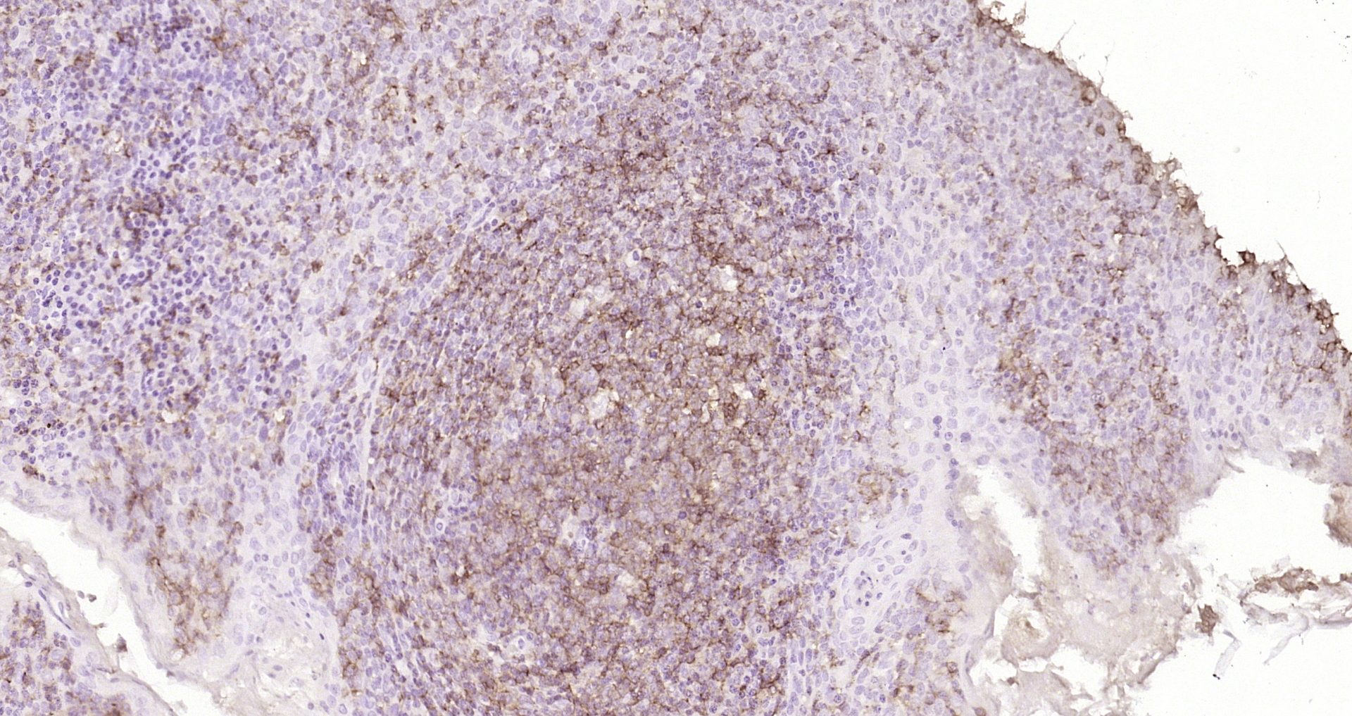 Paraformaldehyde-fixed, paraffin embedded Human tonsil; Antigen retrieval by boiling in sodium citrate buffer (pH6.0) for 15min; Block endogenous peroxidase by 3% hydrogen peroxide for 20 minutes; Blocking buffer (normal goat serum) at 37°C for 30min; Antibody incubation with CD45 Monoclonal Antibody, Unconjugated (bsm-33052M) at 1:200 overnight at 4°C, DAB staining.
