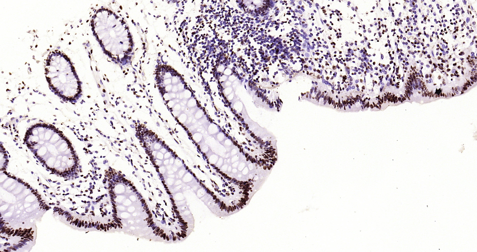 Paraformaldehyde-fixed, paraffin embedded Human colon; Antigen retrieval by boiling in sodium citrate buffer (pH6.0) for 15min; Block endogenous peroxidase by 3% hydrogen peroxide for 20 minutes; Blocking buffer (normal goat serum) at 37°C for 30min; Antibody incubation with Histone H3(di methyl K36) Monoclonal Antibody, Unconjugated (bsm-33124M) at 1:2000 overnight at 4°C, DAB staining.